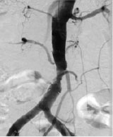 カテーテル治療後