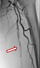 左大腿動脈の閉塞