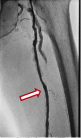 カテーテル治療後