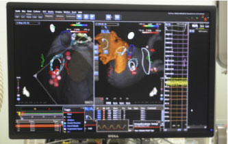 電気生理学的検査