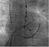 アブレーション中のレントゲン写真