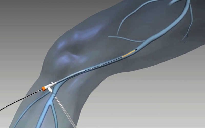 ClosureFASTTM Catheter, ClosureRFGTM