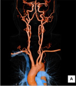 頭頸部3D血管像