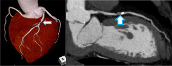 心臓CT冠動脈狭窄像