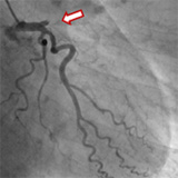 左前下行枝の狭窄