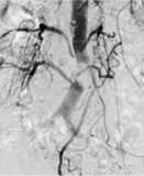 腹部大動脈狭窄