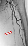 左大腿動脈の狭窄