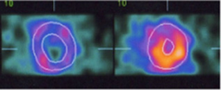 心筋の血流評価 左心室の断層像