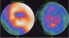 Bull's eye image 左心室の血流評価
