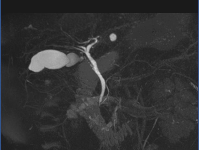 胆のう・膵臓MRI（MRCP)