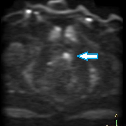 前立腺MRI前立腺がん像