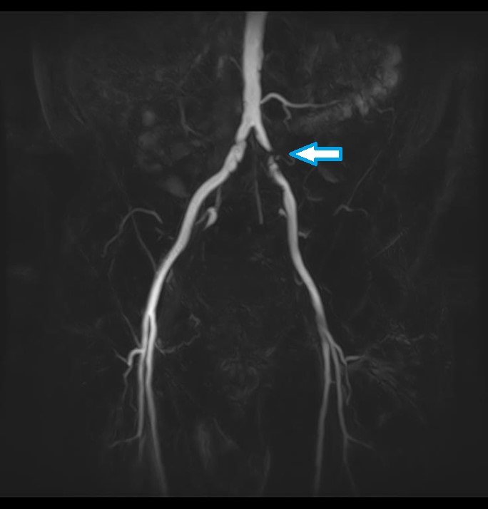 骨盤部MRA大腿動脈狭窄像