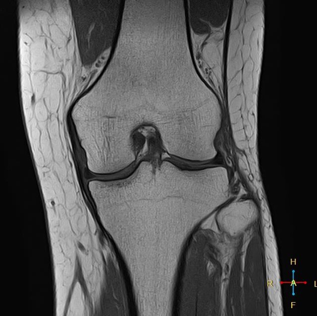 膝関節MRI像
